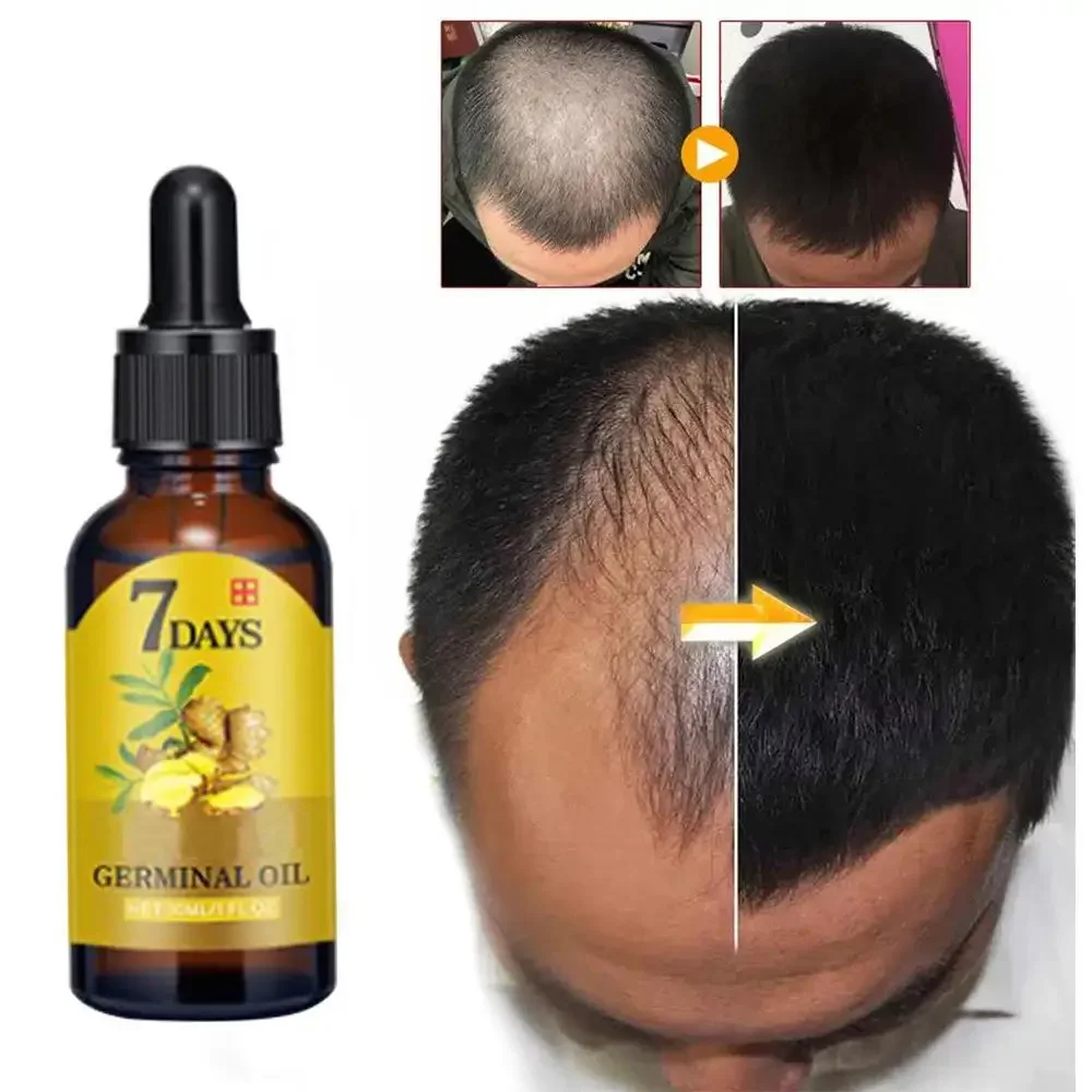 Hair Care Essential Oil Atomizing - Crescimento do cabelo gengibre rápido crescimento